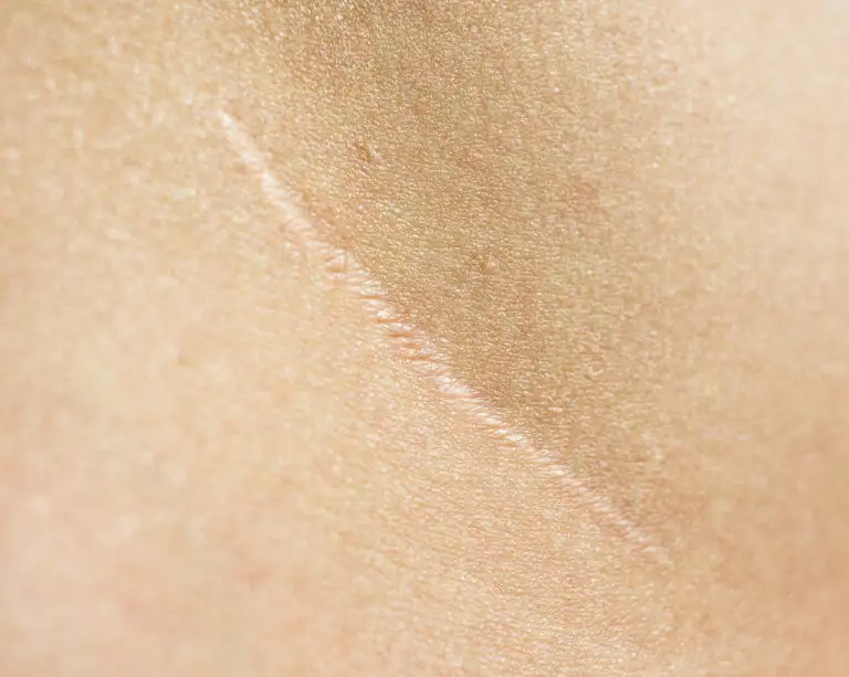 Minimized Scarring